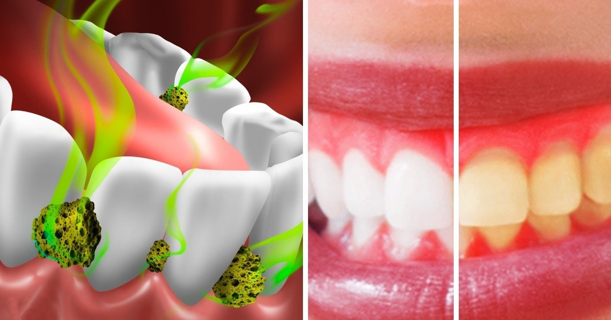 las-7-formas-de-matar-bacterias-en-la-boca-y-detener-el-mal-aliento